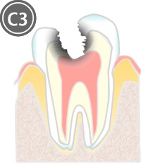 虫歯の段階別治療法