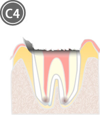 虫歯の段階別治療法